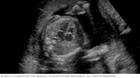 显示婴儿心腔的胎儿超声