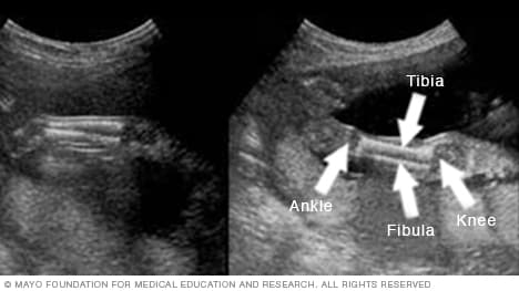 Imagen de ecografía que muestra la parte inferior de las piernas de un feto