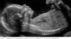 Fetal ultrasound showing baby's profile