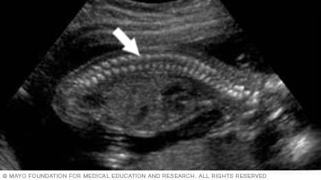 显示胎儿脊柱的胎儿超声