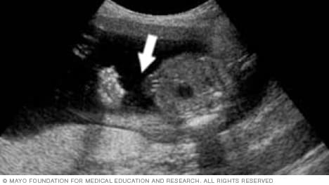 Fetal ultrasound image showing the site of the umbilical cord