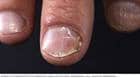 指甲银屑病的图像