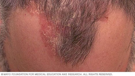 plaque psoriasis scalp