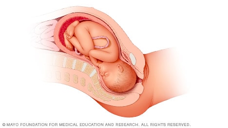 Ilustración de un bebé en posición boca abajo