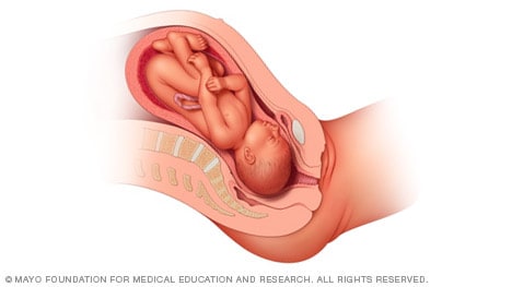 صورة توضيحية لوضعية رأس الجنين للأسفل ووجهه للأعلى