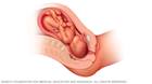 胎儿面部朝上的胎位图示