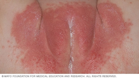 Dermatitis del pañal