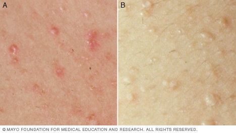 early poison ivy rash