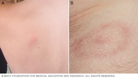 An example of Lyme disease rash