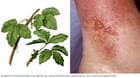 Photo of poison ivy plant and rash