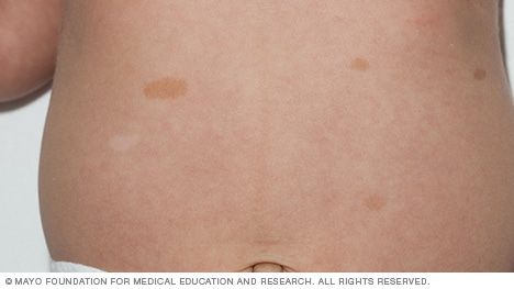 Cafe au lait birthmark
