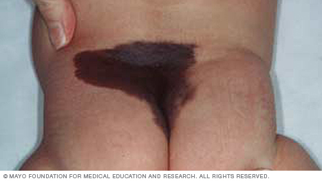 Congenital nevus birthmark