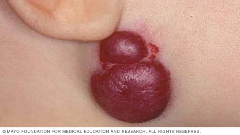 Hemangioma birthmark