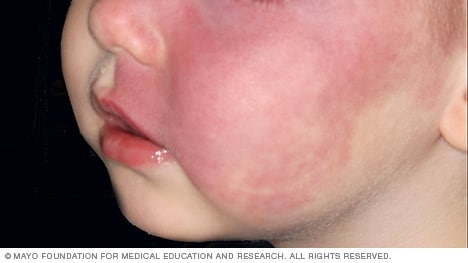 Marca de nacimiento tipo hemangioma plano