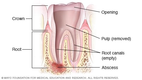 Illustration showing cleaned root canal