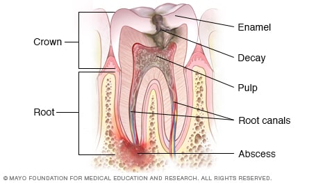 Ilustración de absceso dental y caries antes del tratamiento de conducto