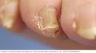 Imagen de una uña engrosada del dedo del pie cortada correctamente