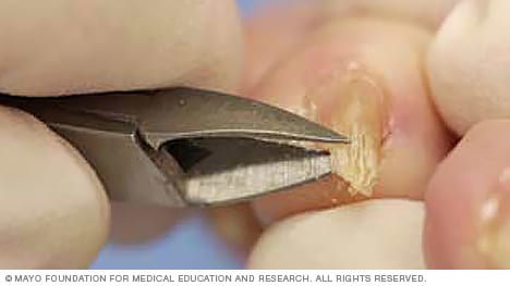 Otro ángulo de un cortaúñas que corta una uña del dedo del pie engrosada