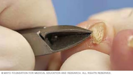 Imagen de un alicate de uñas cortando una uña del dedo del pie engrosada