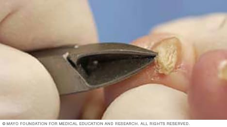 How to trim thickened toenails - Mayo Clinic