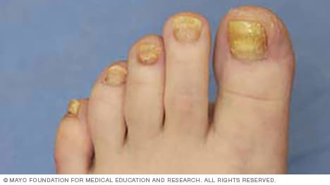 Example of thickened toenails