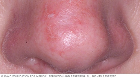 Example of actinic keratoses