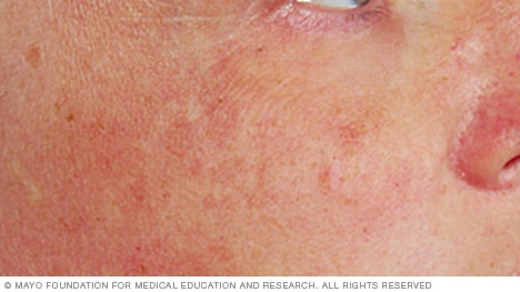Example of blotchy skin with uneven pigmentation