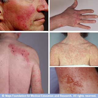 Fotografías de rosácea, psoriasis, erupción medicamentosa, dermatitis de contacto, herpes zóster