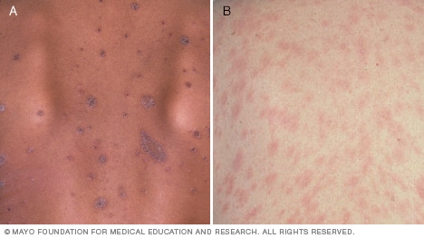 Slide Show Common Skin Rashes Mayo Clinic