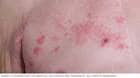 Clusters of shingles blisters appear on one side of the body, here the right chest.