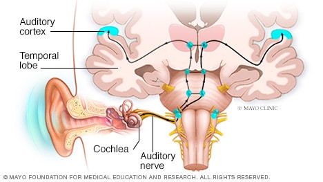 Illustration showing how electrical impulses travel to the brain