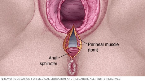 Ilustración de un desgarro vaginal de segundo grado
