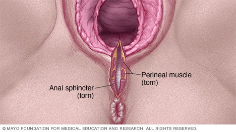 Vaginal Tearing From Sex 70