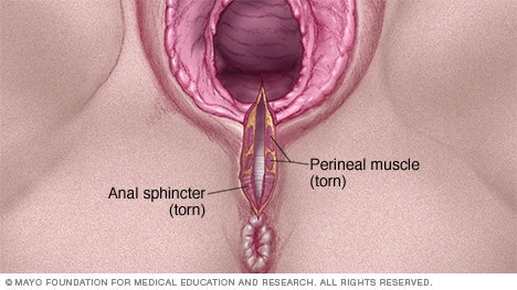 Ilustración de un desgarro vaginal de tercer grado