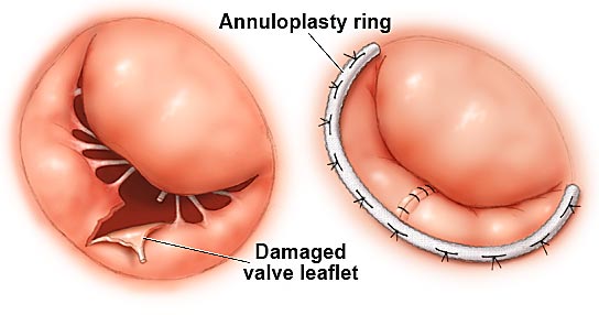 Imagen de una válvula con una valva dañada y una valva reparada con un anillo.