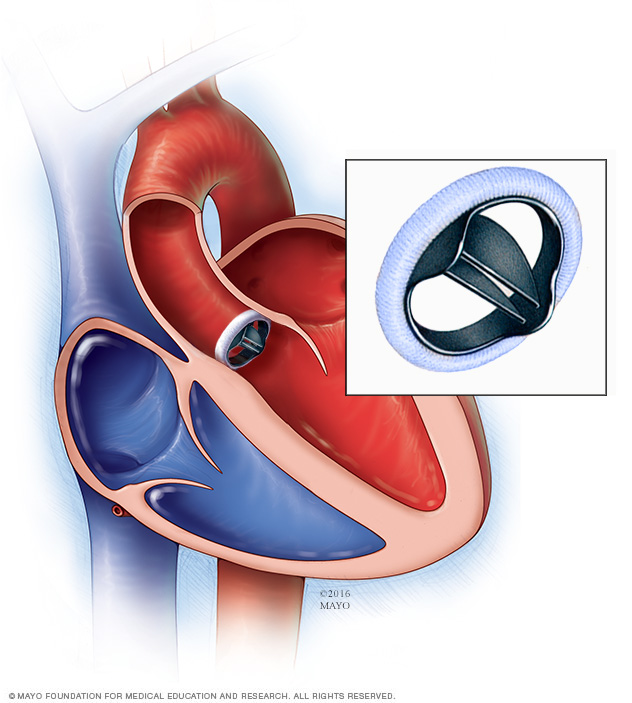 Heart Valve Surgery Mayo Clinic