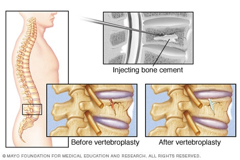 Columna vertebral y aguja que inyecta cemento en una vértebra fisurada