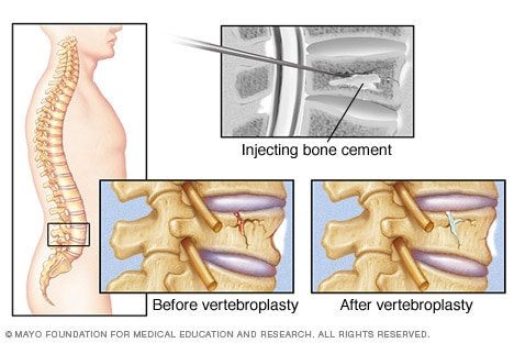 العمود الفقري وإبرة تحقن الإسمنت في فقرة مكسورة