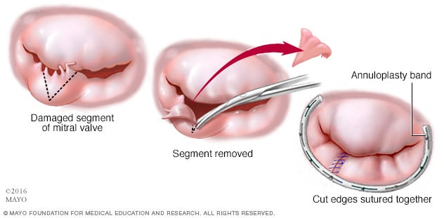 Reparación de la válvula mitral