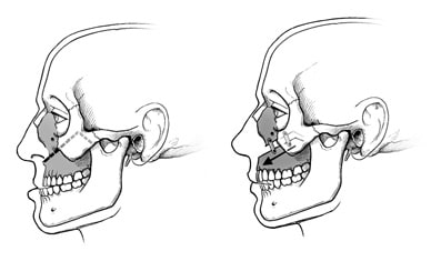 在上颚部手术中，外科医生会将上颌骨切开，然后根据需要向前、向后、向上或向下移动，并用钢板和螺钉固定。 