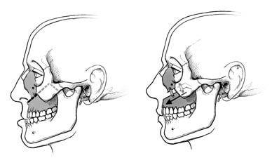 Upper jaw surgery