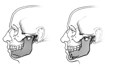 Jaw Surgery Mayo Clinic