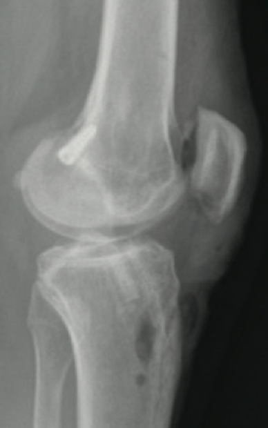 Postoperative radiograph of lateral view