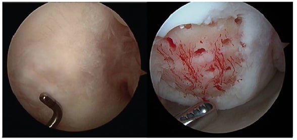 Post-microfracture image of well-contained cartilage defect