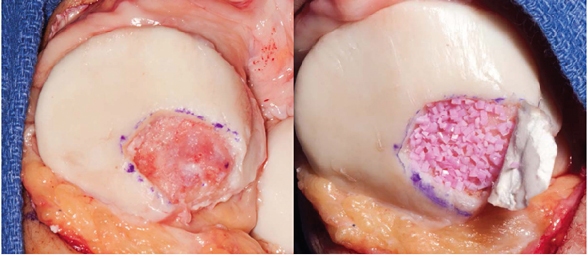 Juvenile particulated chondral allograft transplant
