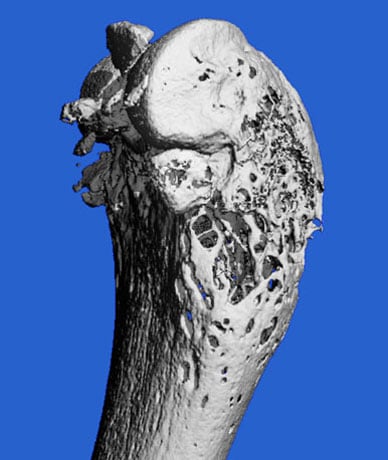 MicroCT scan image of bone loss