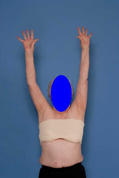 Photo showing excellent range of motion postoperatively