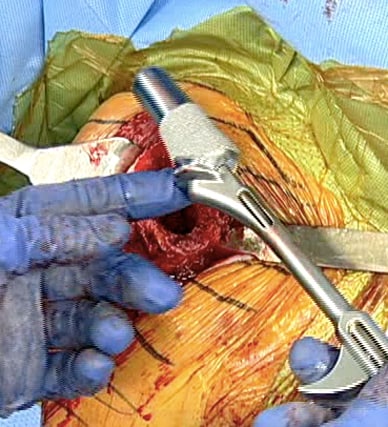 Photo of newer bone-preserving ultrashort humeral component