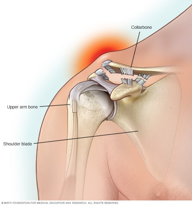 Separated shoulder