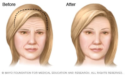Ilustración de los resultados de la ritidoplastia frontal